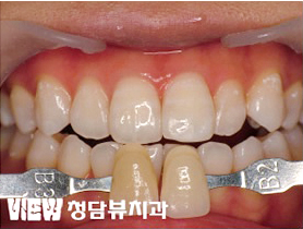 치아미백
